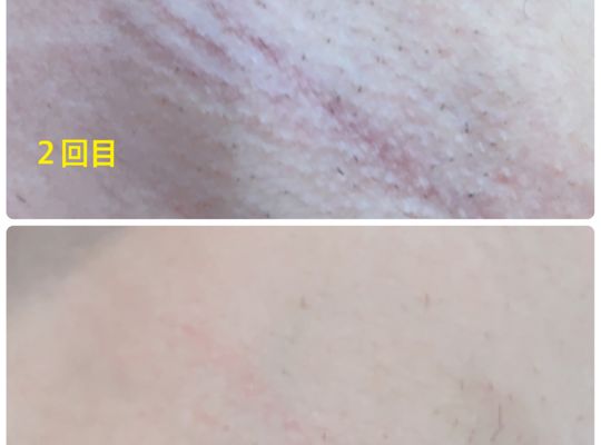 脱毛　施術には個人差がございます