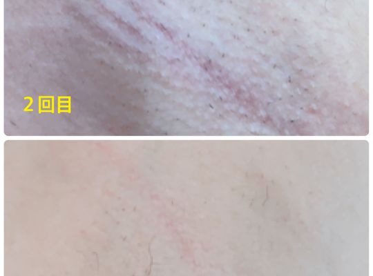脱毛 施術には個人差がございます。