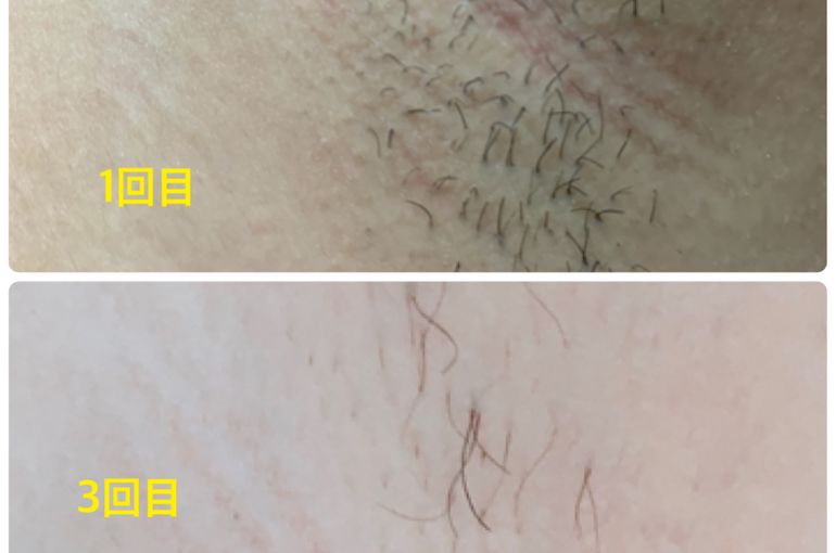 脱毛　施術には個人差がございます。