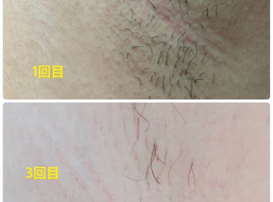 ワキ脱毛　施術には個人差がございます。