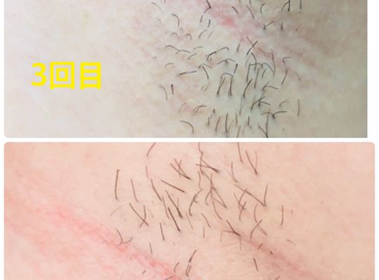 脱毛