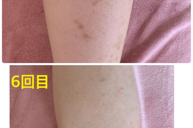 脱毛
